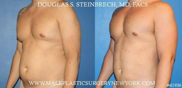 Gynecomastia Surgery result at Gotham Plastic Surgery in New York, NY