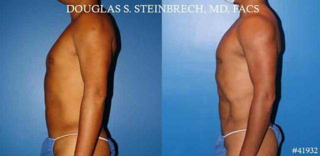 Fat Transfer result at Gotham Plastic Surgery in New York, NY