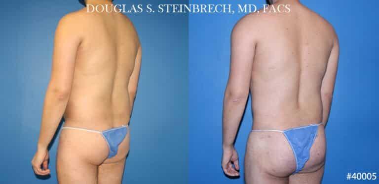 Gotham Plastic Surgery liposuction result — New York, NY