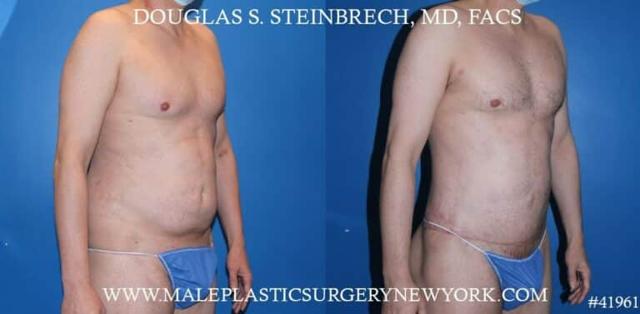 Gynecomastia Surgery result at Gotham Plastic Surgery in New York, NY