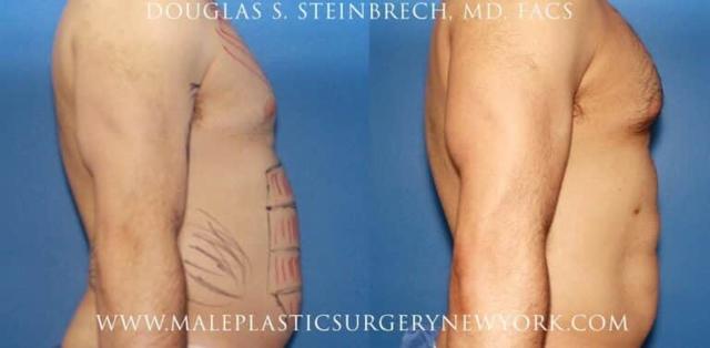 Thigh Lift result at Gotham Plastic Surgery in New York, NY