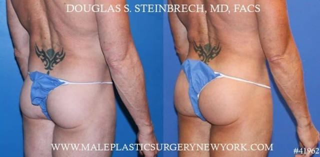 Brazilian Butt Lift result at Gotham Plastic Surgery in New York, NY