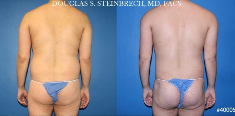 Gotham Plastic Surgery liposuction result — New York, NY