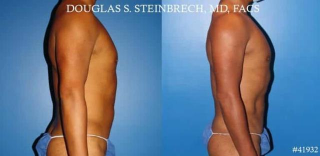 Fat Transfer result at Gotham Plastic Surgery in New York, NY