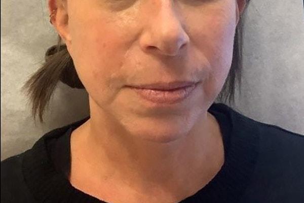 Neck Lift after at Mary Ella Carter, MD in Washington, DC