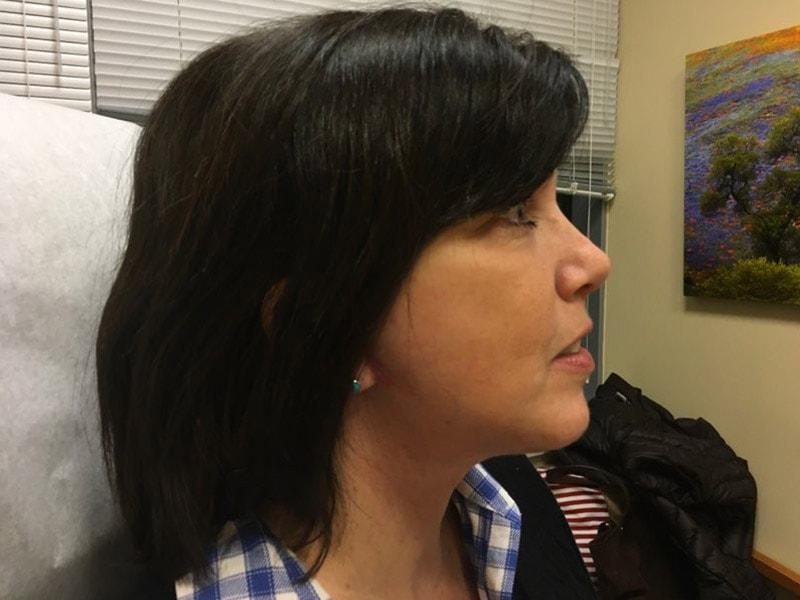 Mary Ella Carter, MD facelift after — Washington, DC