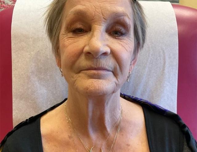 Neck Lift before at Mary Ella Carter, MD in Washington, DC