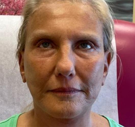 Mary Ella Carter, MD facelift after — Washington, DC