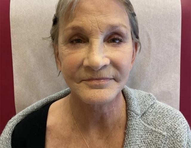 Neck Lift after at Mary Ella Carter, MD in Washington, DC