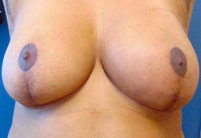 Breast Lift after at Mary Ella Carter, MD in Washington, DC