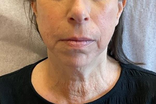 Neck Lift before at Mary Ella Carter, MD in Washington, DC