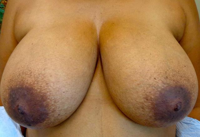 Breast Lift before at Mary Ella Carter, MD in Washington, DC