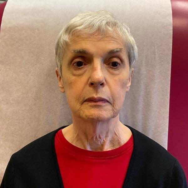 Neck Lift before at Mary Ella Carter, MD in Washington, DC