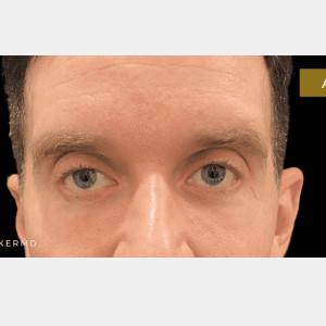Blepharoplasty after at Plastic Surgery Center of Dallas in Dallas, TX