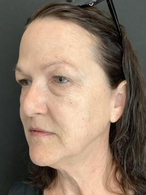 Facelift before at Plastic Surgery Center of Dallas in Dallas, TX