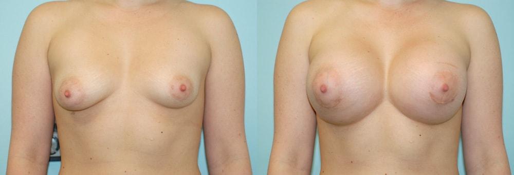 M Hugh Bailey, MD breast augmentation result — Newport Beach, CA