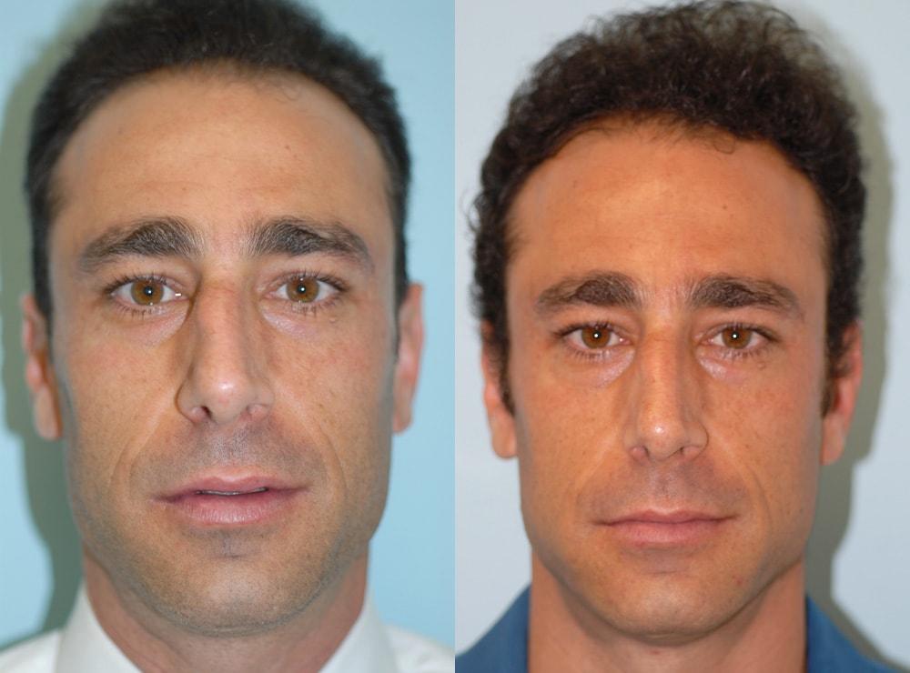 M Hugh Bailey, MD rhinoplasty result — Newport Beach, CA