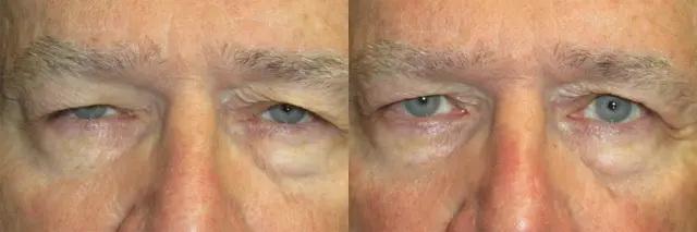 Neck Lift result at OPAL Aesthetics - East Cobb in Marietta, GA