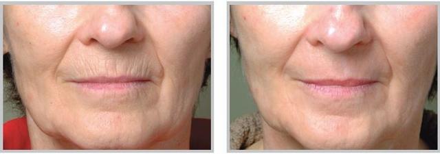 Chemical Peel result at OPAL Aesthetics - East Cobb in Marietta, GA