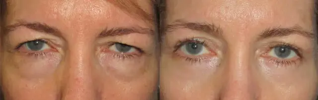 Neck Lift result at OPAL Aesthetics - East Cobb in Marietta, GA