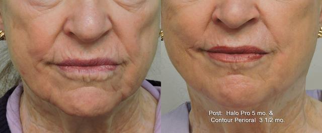 Chemical Peel result at OPAL Aesthetics - East Cobb in Marietta, GA