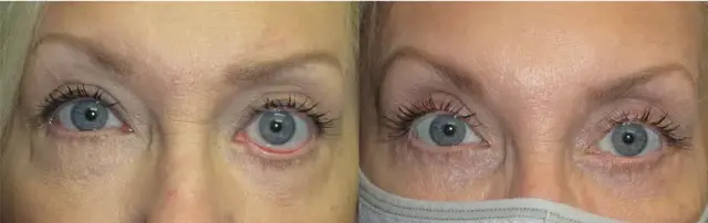 Neck Lift result at OPAL Aesthetics - East Cobb in Marietta, GA