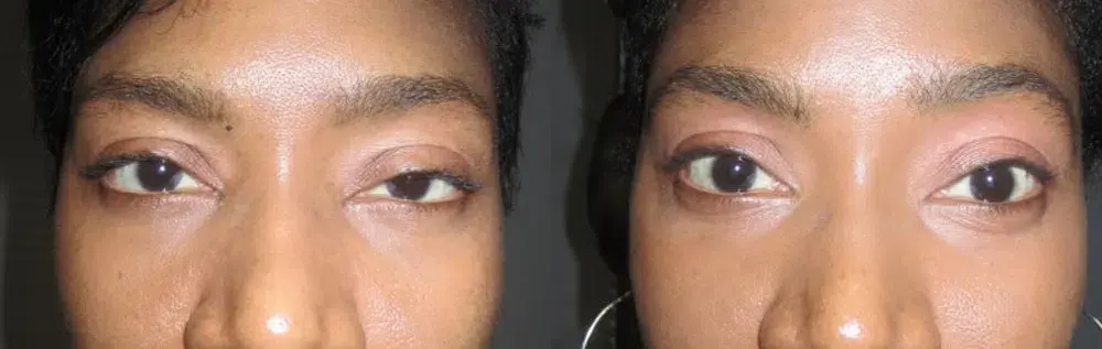 OPAL Aesthetics - East Cobb facelift result — Marietta, GA
