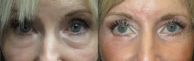 Blepharoplasty result at OPAL Aesthetics - East Cobb in Marietta, GA