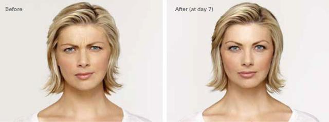Botox result at OPAL Aesthetics - East Cobb in Marietta, GA