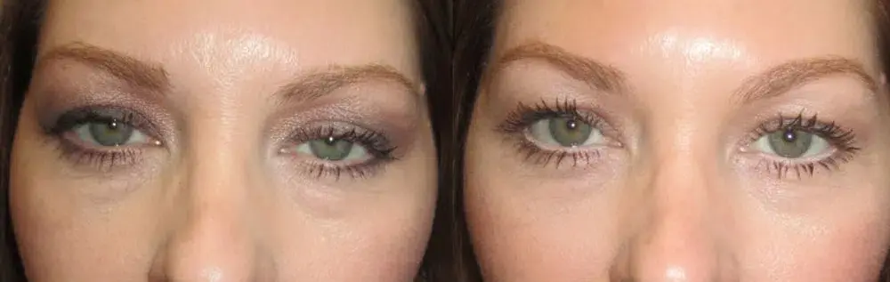 OPAL Aesthetics - East Cobb facelift result — Marietta, GA