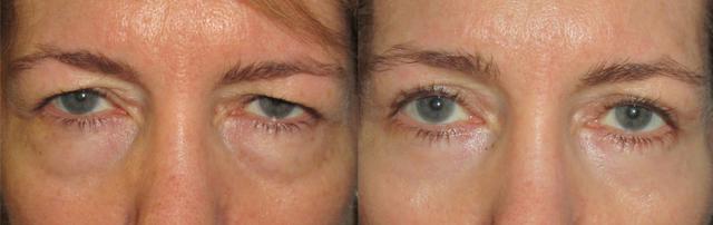 Brow Lift result at OPAL Aesthetics - East Cobb in Marietta, GA