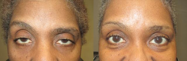 Blepharoplasty result at OPAL Aesthetics - East Cobb in Marietta, GA