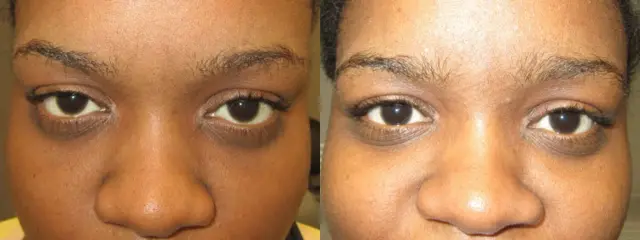 Facelift result at OPAL Aesthetics - East Cobb in Marietta, GA