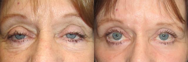 Blepharoplasty result at OPAL Aesthetics - East Cobb in Marietta, GA