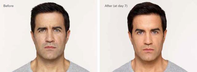 Botox result at OPAL Aesthetics - East Cobb in Marietta, GA