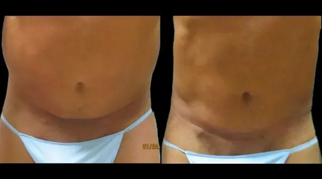 Tummy Tuck result at Colgrove Plastic Surgery (Vinings) in Atlanta, GA