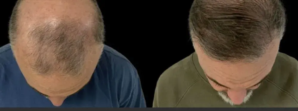 Colgrove Plastic Surgery (Vinings) hair restoration result — Atlanta, GA