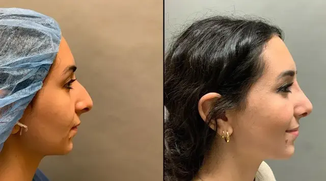 Ethnic Rhinoplasty result at Colgrove Plastic Surgery (Vinings) in Atlanta, GA