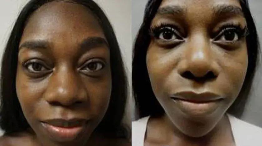 Colgrove Plastic Surgery (Vinings) rhinoplasty result — Atlanta, GA