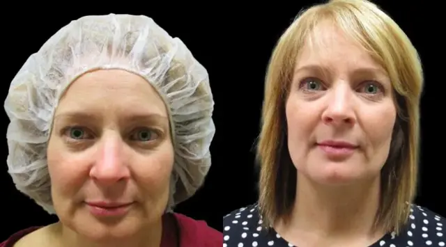 Facelift result at Colgrove Plastic Surgery (Vinings) in Atlanta, GA