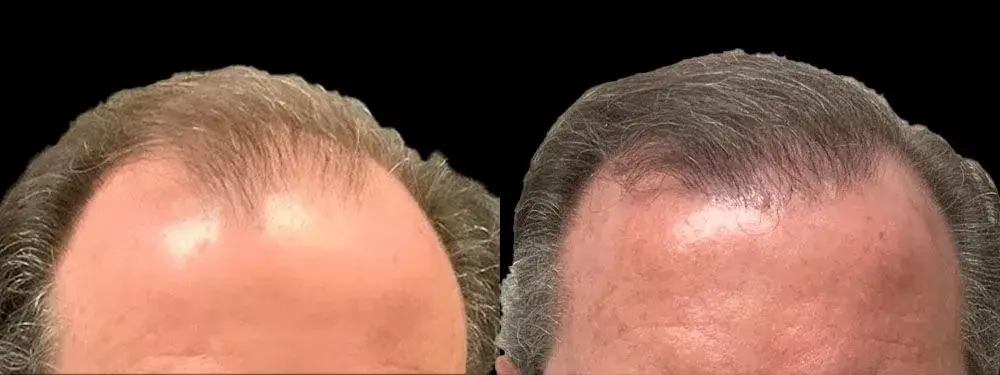 Colgrove Plastic Surgery (Vinings) hair restoration result — Atlanta, GA