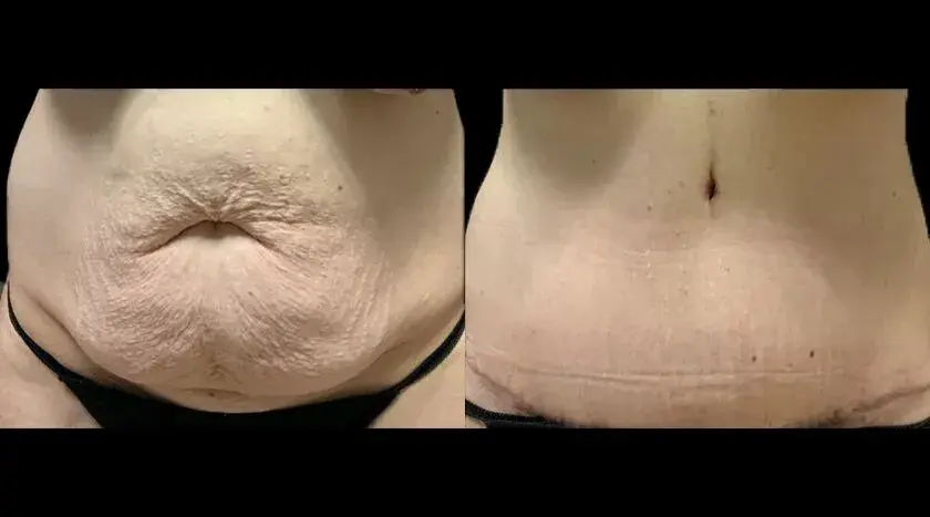 Colgrove Plastic Surgery (Vinings) tummy tuck result — Atlanta, GA