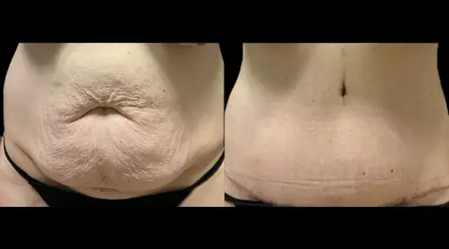 Tummy Tuck result at Colgrove Plastic Surgery (Vinings) in Atlanta, GA