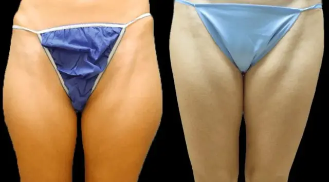 Liposuction result at Colgrove Plastic Surgery (Vinings) in Atlanta, GA