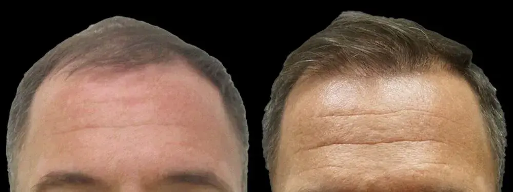 Colgrove Plastic Surgery (Vinings) hair restoration result — Atlanta, GA