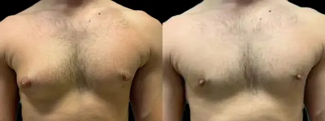 Gynecomastia Surgery result at Colgrove Plastic Surgery (Vinings) in Atlanta, GA