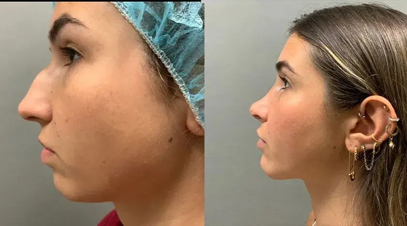 Colgrove Plastic Surgery (Vinings) rhinoplasty result — Atlanta, GA