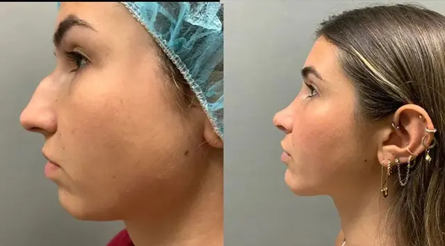 Ethnic Rhinoplasty result at Colgrove Plastic Surgery (Vinings) in Atlanta, GA