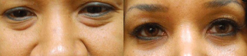 Colgrove Plastic Surgery (Vinings) blepharoplasty result — Atlanta, GA