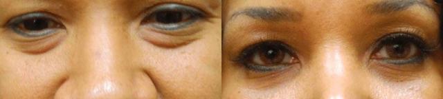 Blepharoplasty result at Colgrove Plastic Surgery (Vinings) in Atlanta, GA